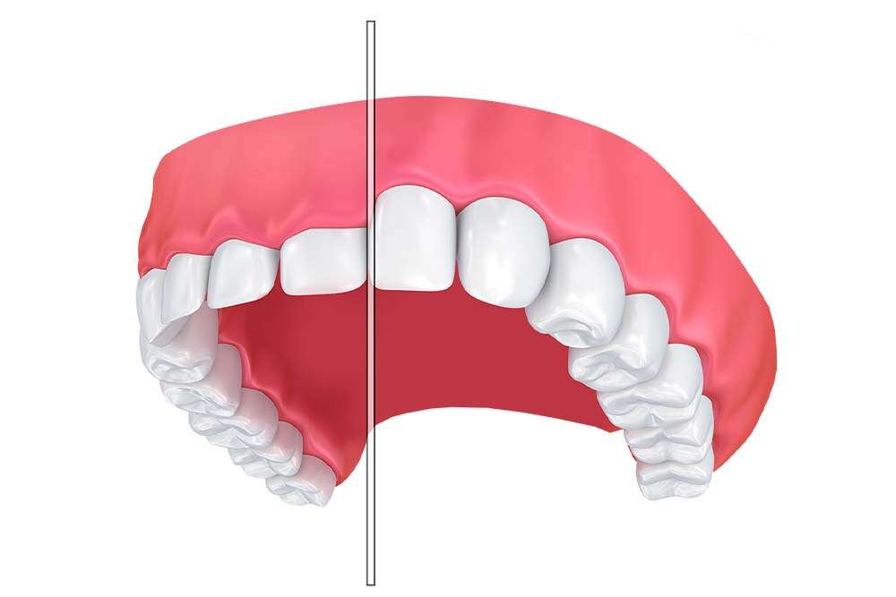 Illustrazione del contorno gengivale per i denti.