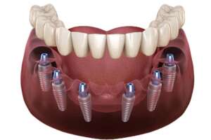 Ilustración de cómo se colocan 6 implantes en la boca.