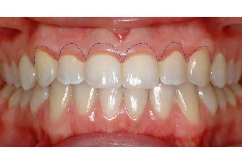 Ziehen Sie die Linie für die Laser-Zahnfleisch-Reshaping-Verfahren.
