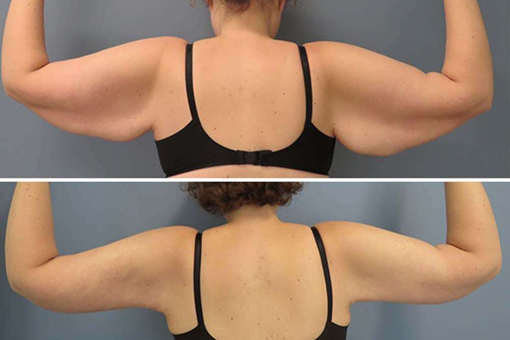 Foto de la espalda de una mujer antes de someterse a una operación de lifting de brazos y después del tratamiento en clínicas médicas de Albania.
