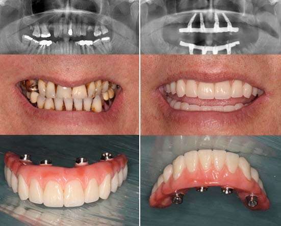 Todo en 4 implantes dentales Albania. 