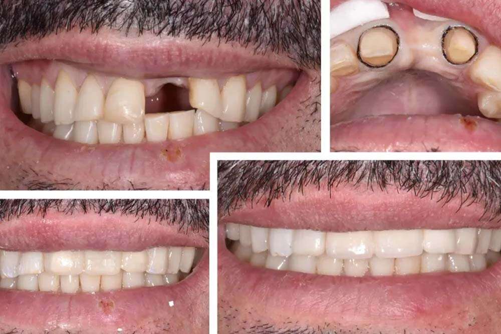 Before after dental bridges in Albania. 