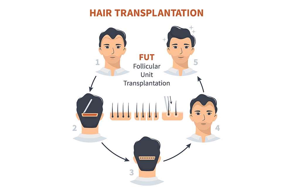 Procedimiento Fut Hair Transplant Albania para hombre (masculino). 
