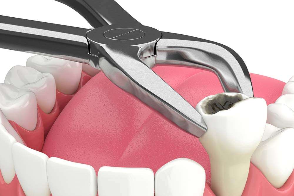Removing tooth before implant. 