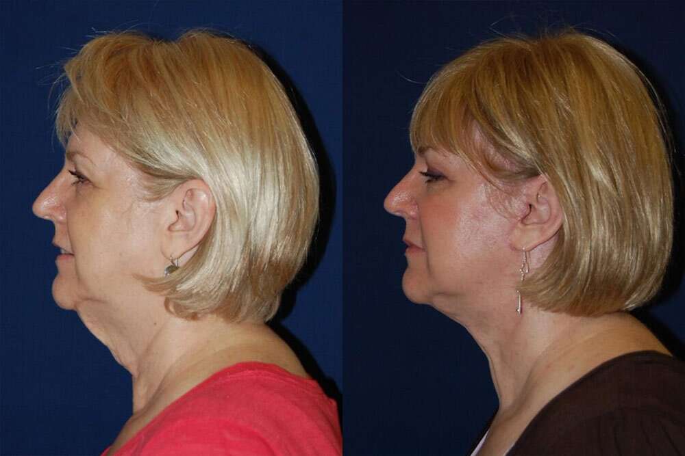 The best affordable facelift surgery in Albania