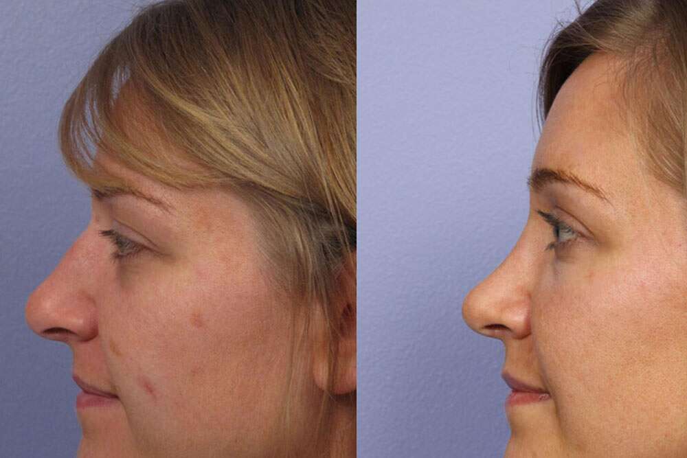 Donna straordinaria prima e dopo l'intervento chirurgico di sollevamento della punta del naso in Albania