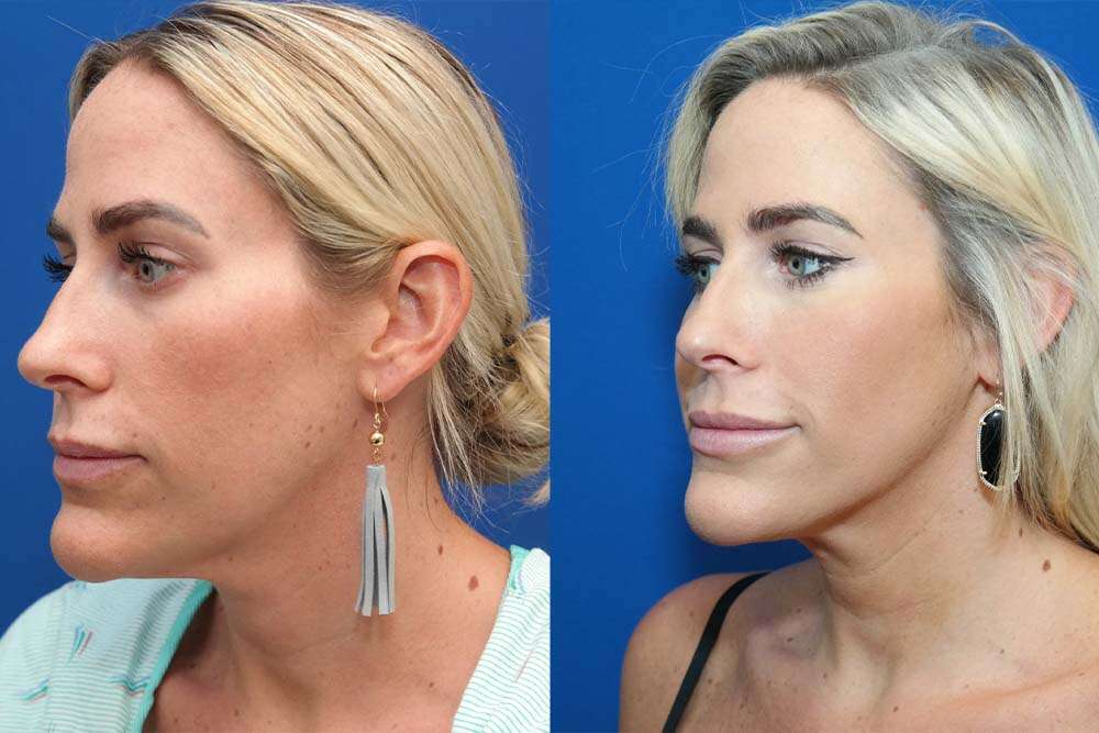 Woman chin liposuction in Albania