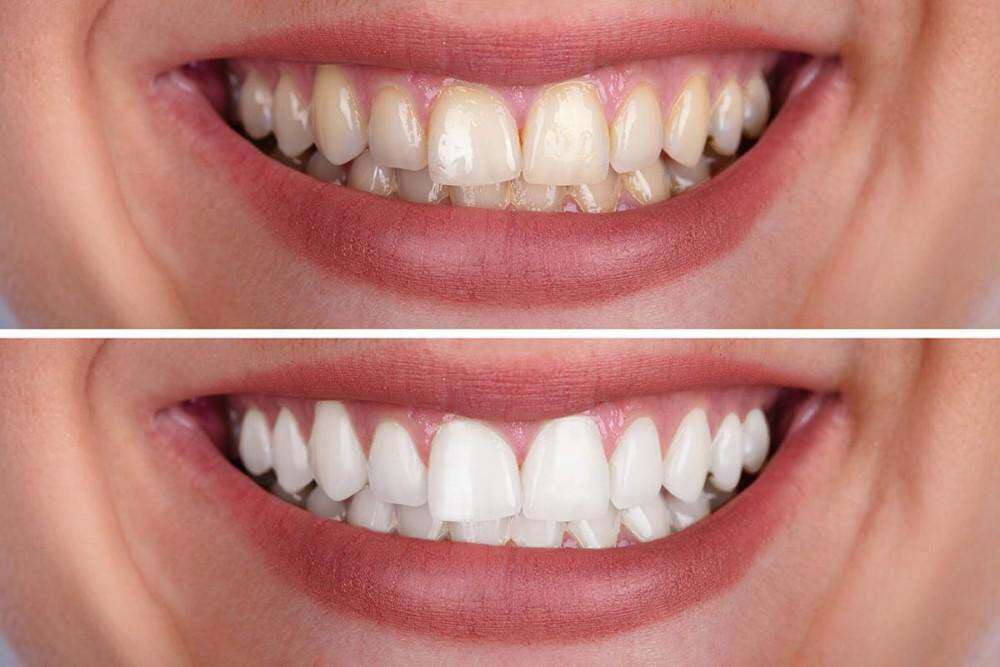 Woman smiling before and after teeth whitening procedure in Tirana.