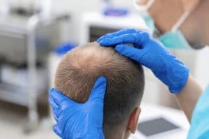 Immagine che illustra un intervento di trapianto di capelli in Albania.