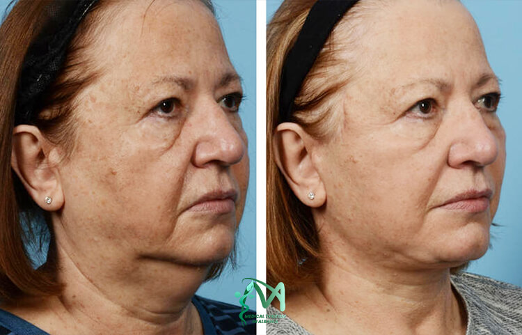 Woman face lift in Albania.