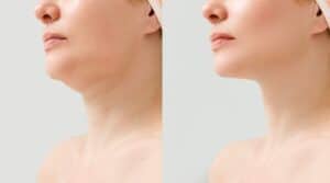 Bild, das die erstaunlichen Ergebnisse einer Doppelkinn-Liposuktion in Albanien zeigt