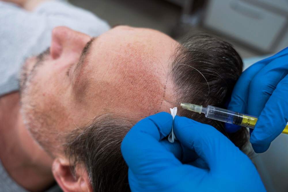 PRP therapy in Albania for correcting a receding hairline.
