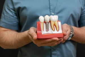 Implantes dentales all on 4 asequibles en Albania para la sustitución de dientes