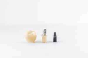 Image illustrating dental implants in Albania
