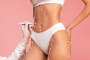 Image illustrating an affordable liposuction procedure in Albania
