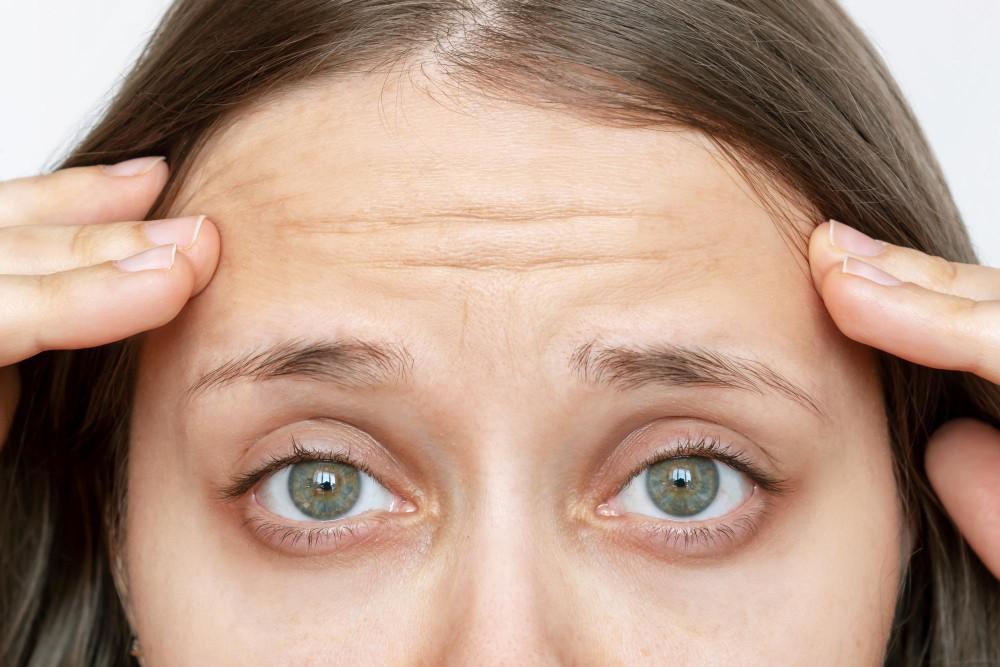Image illustrating forehead wrinkles that can be removed with a chemical deep peel