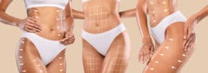 Women with body contouring markings, preparing for cosmetic procedures.