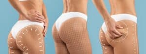 Woman's buttocks after lift procedure, showing improved shape and firmness.