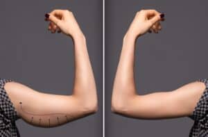Arm lift procedure results showing toned arms in Albania for medical tourism.