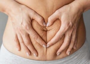 Woman's abdomen with heart-shaped hands forming a heart over stretch marks.