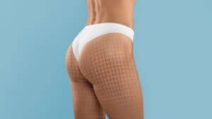 Woman's buttocks after Brazilian Butt Lift procedure in Albania.