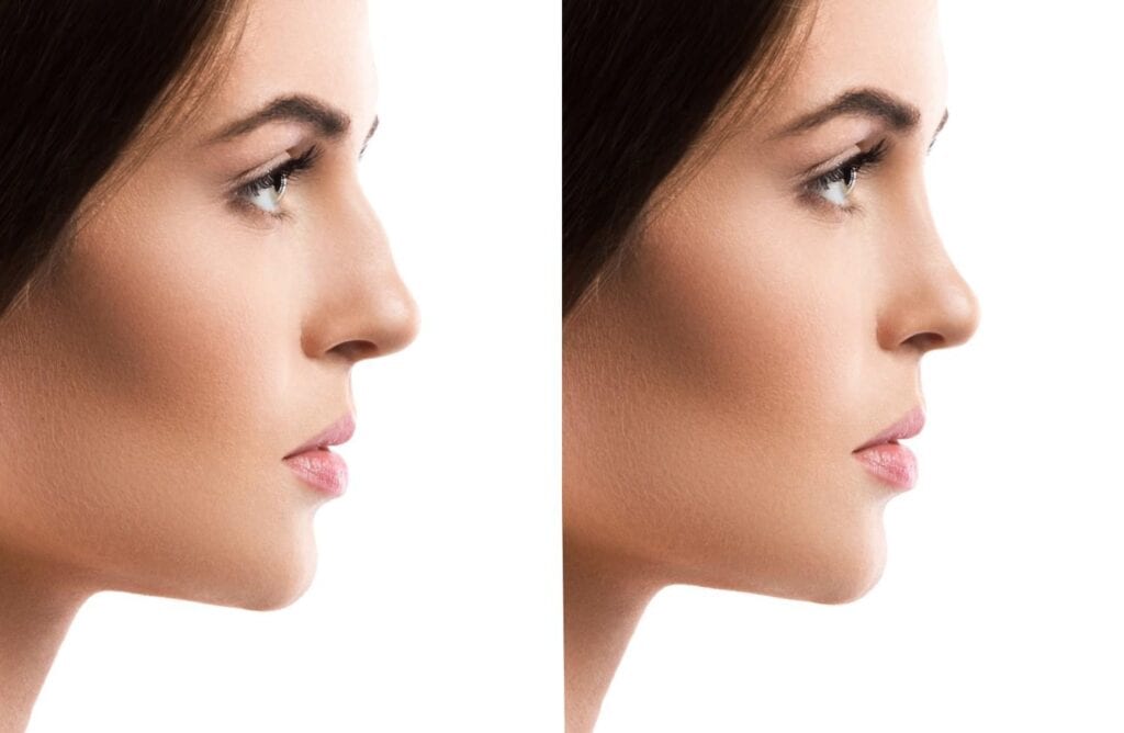 Rhinoplasty procedure in Albania for affordable aesthetic enhancement.