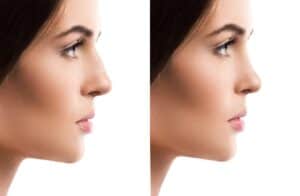 Rhinoplasty procedure in Albania for affordable aesthetic enhancement.