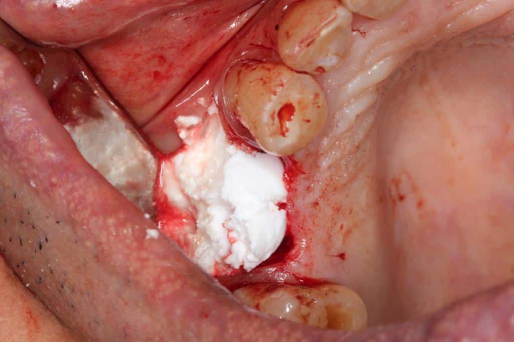 Bone Grafting procedure in Albania