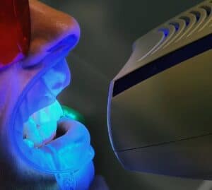 Person undergoing teeth whitening with LED light in Albania dental clinic.