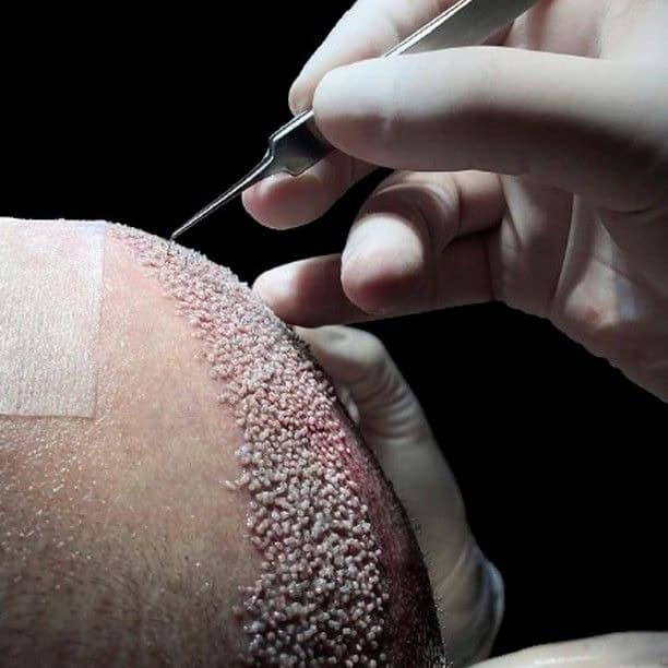 Procedura e transplantit të flokëve Sapphire Fue në Shqipëri