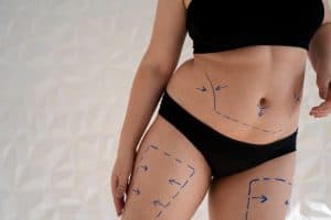 Woman with marked body areas for liposuction and body contouring in Albania.