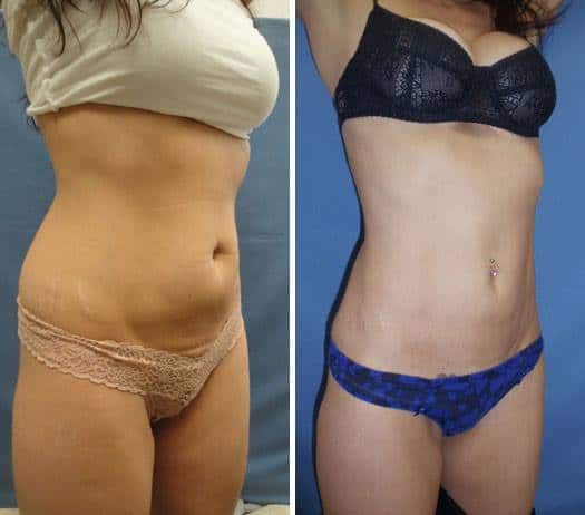 Mons Pubis Reduction before after