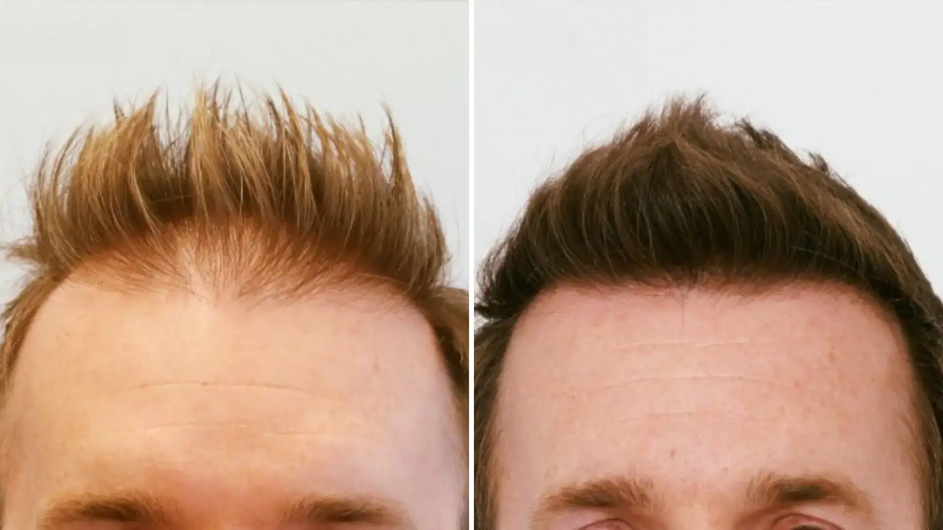 Transplantation de cheveux d'apparence naturelle en Albanie
