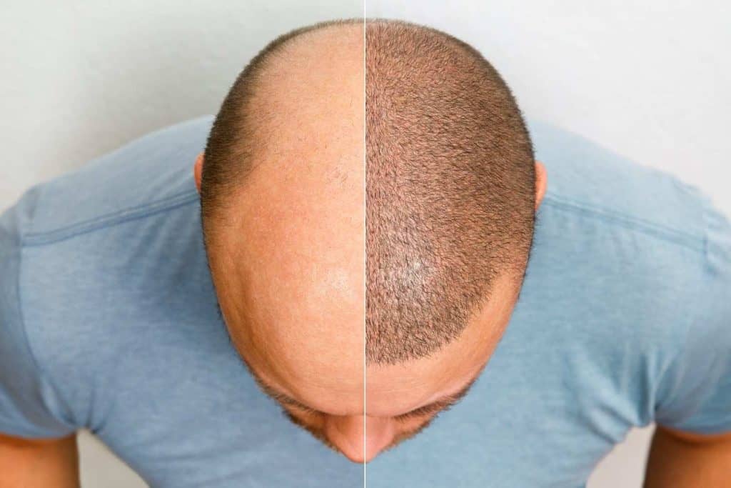 Man met haarverlies voor en na haartransplantatie in Albanië.