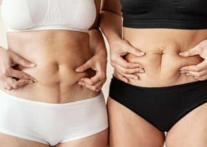 Women showing their post-surgery stomachs after tummy tuck and liposuction in Albania.