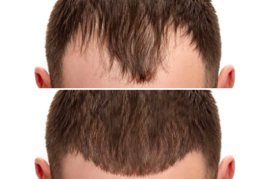 Haartransplantatie in Albanië, natuurlijke haarherstel, betaalbaar medisch toerisme.