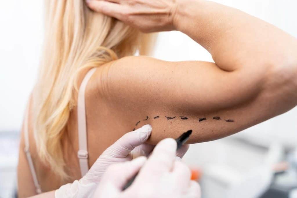 Woman receiving cosmetic arm surgery in Albania for aesthetic enhancement.