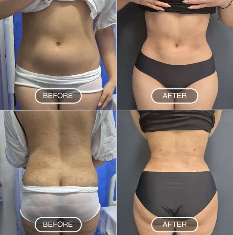 Liposuction in Albania
