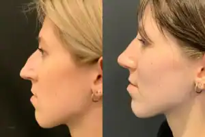 Procedura e reduktimit të bazës së hundës që tregon gjerësi dhe simetri të përmirësuar të hundës.