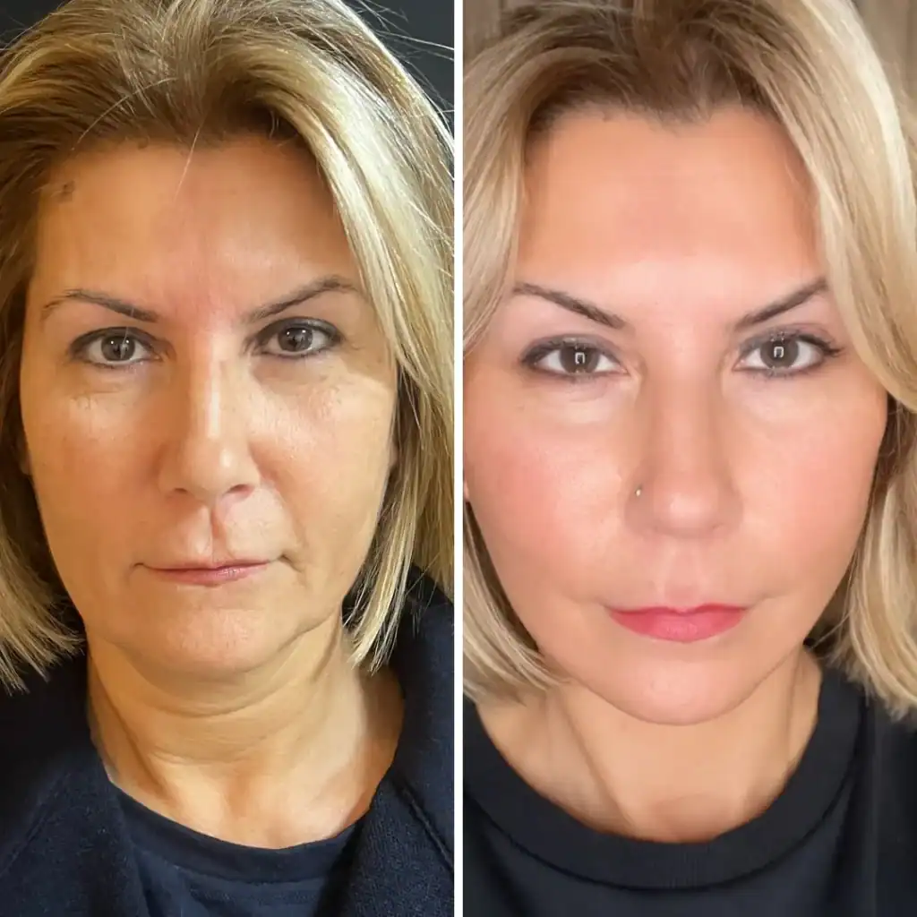 Para dhe pas facelift-it të plotë të fytyrës duke treguar rigjenerim rinor të fytyrës.