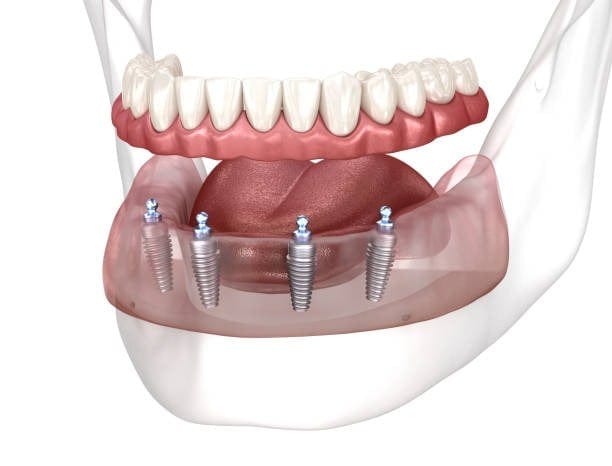 Dental implant comparison: All-on-4 vs All-on-6 for full-arch solutions.