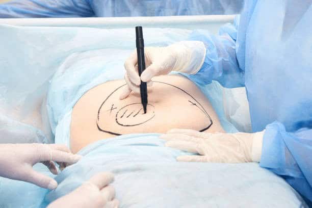 Surgical procedure for extended tummy tuck in Albania for medical tourism.