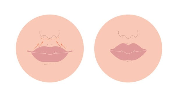 Illustration of lip lift vs lip fillers for cosmetic enhancement.