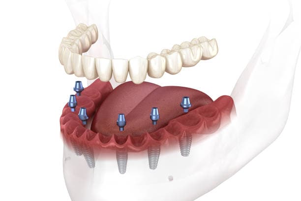 Full-arch dental implant with All-on-4 and All-on-6 options in Albania.