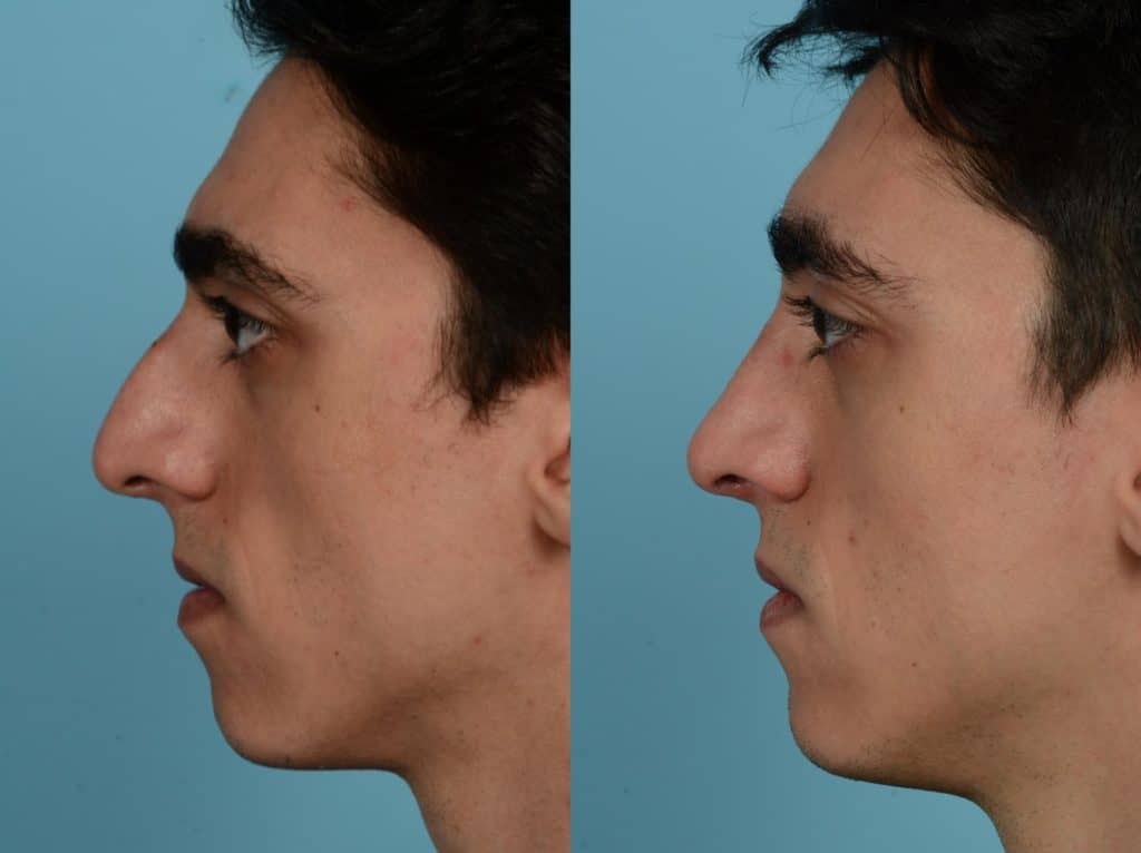 Side profile of a man showing nasal correction after septoplasty.
