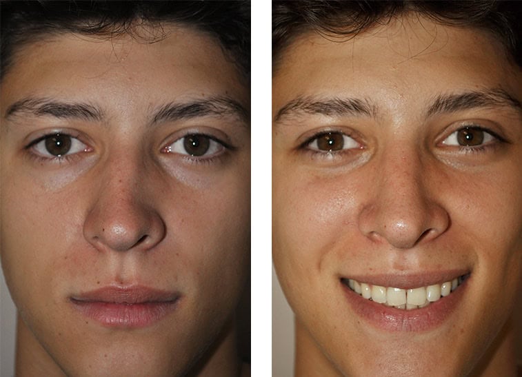 Nasal septoplasty results showing improved nasal symmetry and breathing.