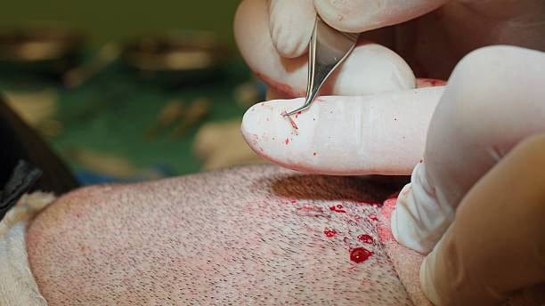 Medical professional performing hair transplant in Albania for hair restoration.