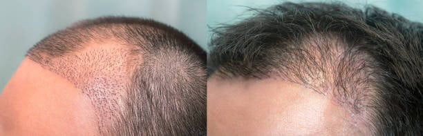 Hair transplant procedure in Albania showing before and after results.