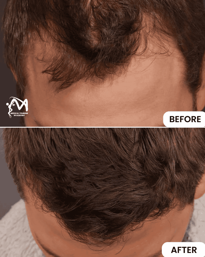 Before and after hair transplant in Albania showing hair restoration results.