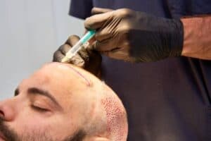 Doctor performing hair transplant on patient with local anesthesia in Albania.